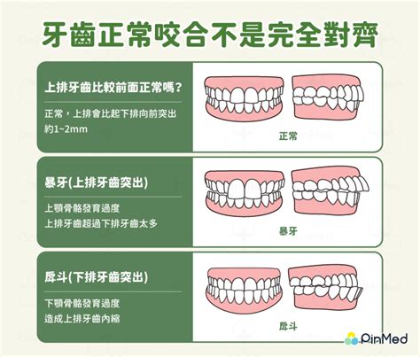 上下排牙齒平行|上下排牙齒貼到實 竟然不是正常的咬合？(上) 